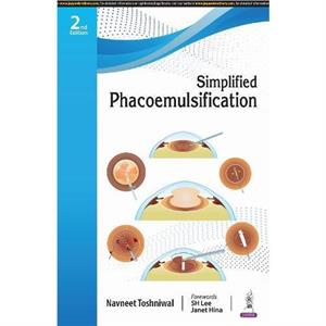 Simplified Phacoemulsification by Navneet Toshniwal