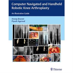 Computer Navigated and Handheld Robotic Knee Arthroplasty by Piyush Agarwal